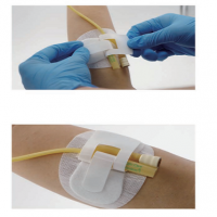 Urethral Catheter Fixation Device